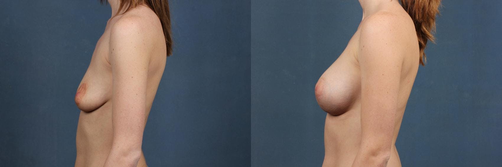 Lift Before & After Gallery - Patient 382221 - Image 3