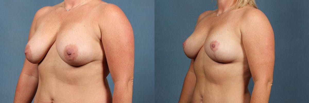 Lift Before & After Gallery - Patient 249125 - Image 2