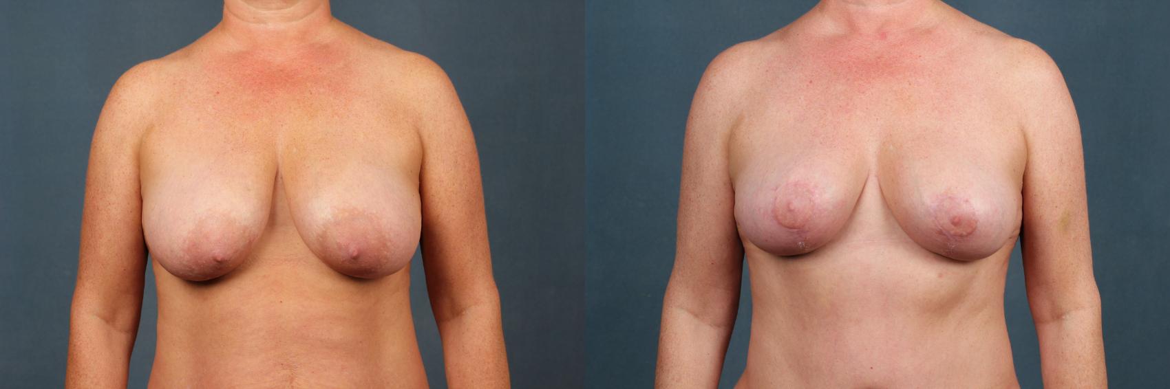breast lift results