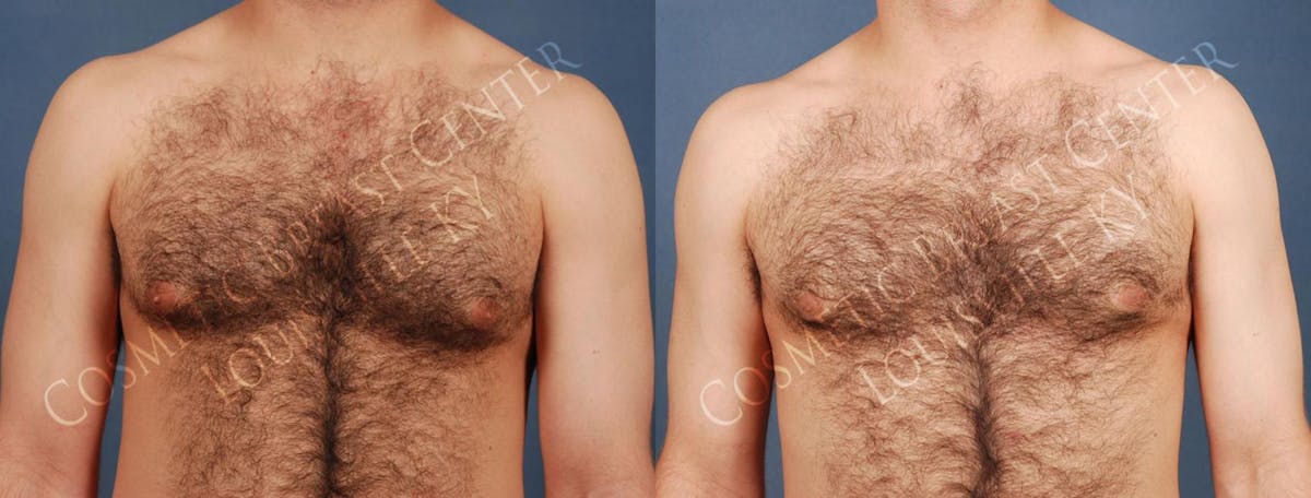 Male Reduction Before & After Gallery - Patient 305025 - Image 1
