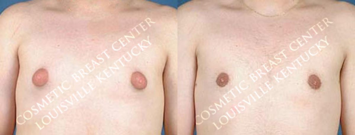 Male Reduction Before & After Gallery - Patient 366658 - Image 1