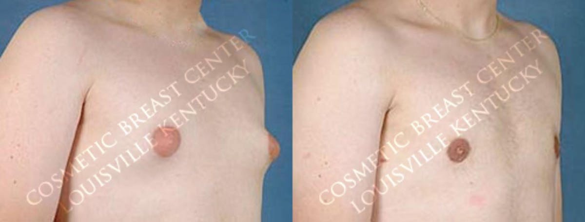 Male Reduction Before & After Gallery - Patient 366658 - Image 2