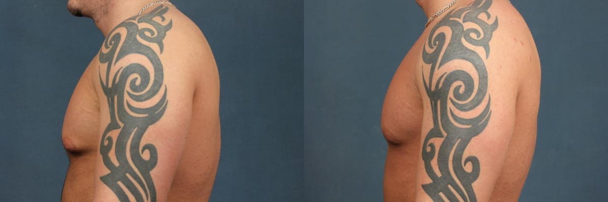 Male Reduction Before & After Gallery - Patient 314252 - Image 3