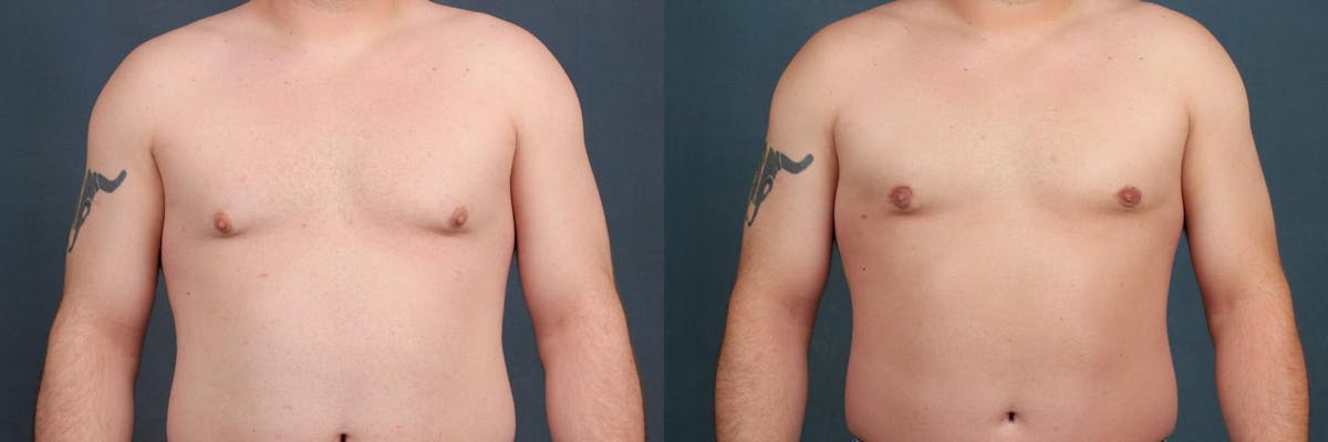 Male Reduction Before & After Gallery - Patient 333741 - Image 1