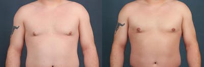 Male Reduction Before & After Gallery - Patient 333741 - Image 1