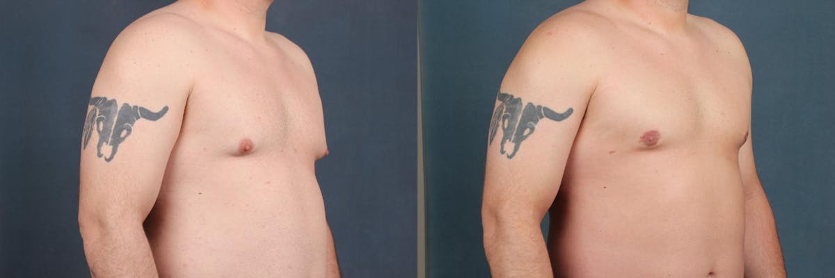 Male Reduction Before & After Gallery - Patient 333741 - Image 3
