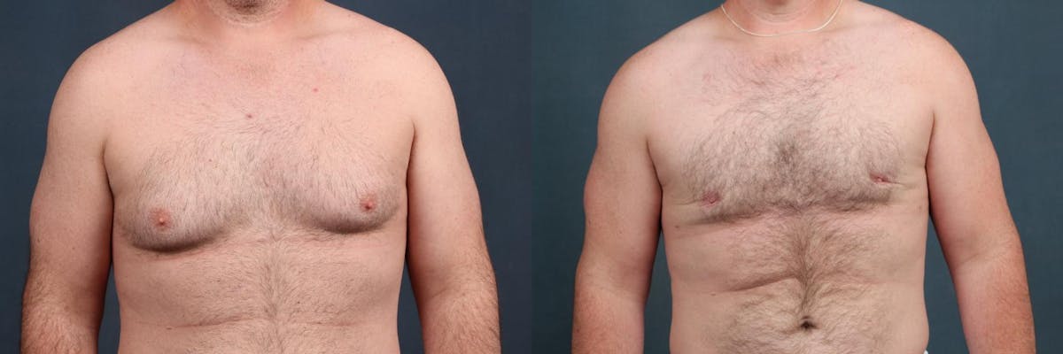 Male Breast Reduction Before & After Gallery - Patient 687084 - Image 1
