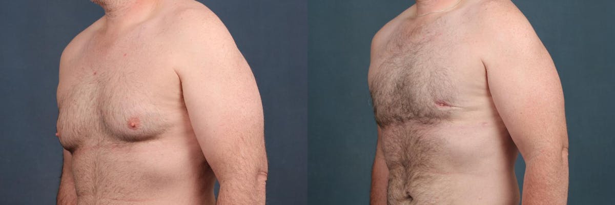 Male Breast Reduction Before & After Gallery - Patient 687084 - Image 2