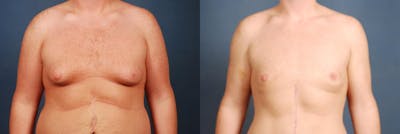 Male Reduction Before & After Gallery - Patient 375427 - Image 1