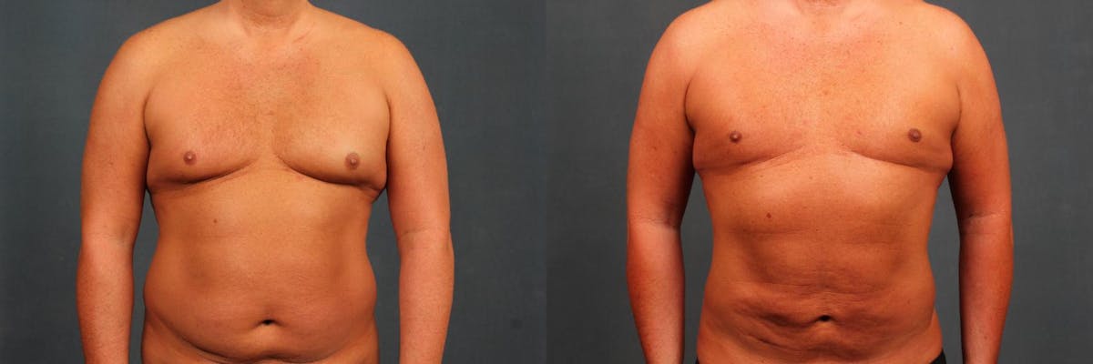 Male Reduction Before & After Gallery - Patient 374443 - Image 1