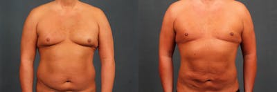 Male Reduction Before & After Gallery - Patient 374443 - Image 1