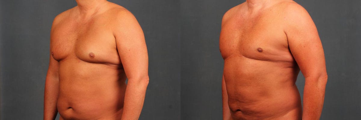 Male Reduction Before & After Gallery - Patient 374443 - Image 2