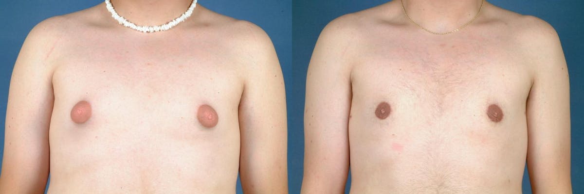 Male Breast Reduction Before & After Gallery - Patient 350407 - Image 1