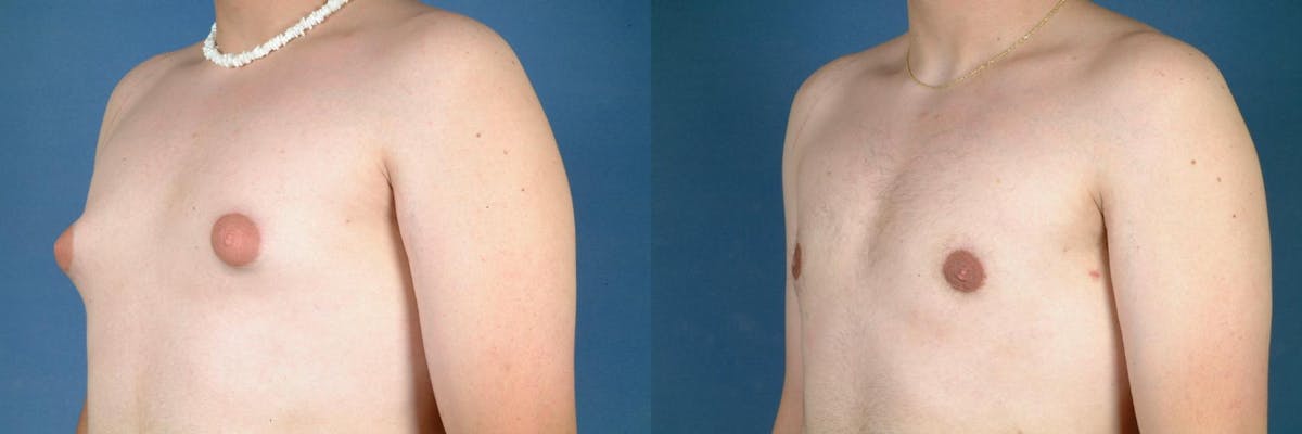 Male Breast Reduction Before & After Gallery - Patient 350407 - Image 2