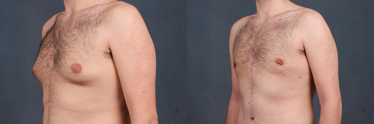 Male Reduction Before & After Gallery - Patient 144138 - Image 2