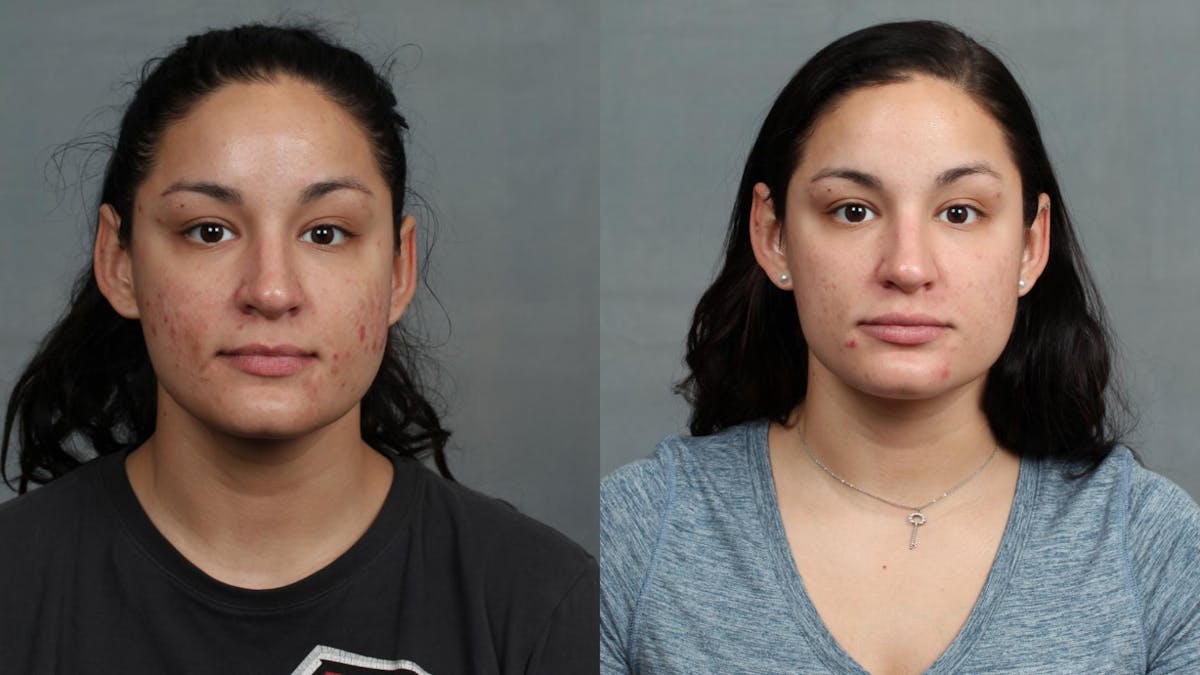 Advanced Medical Facials Before & After Gallery - Patient 583528 - Image 1