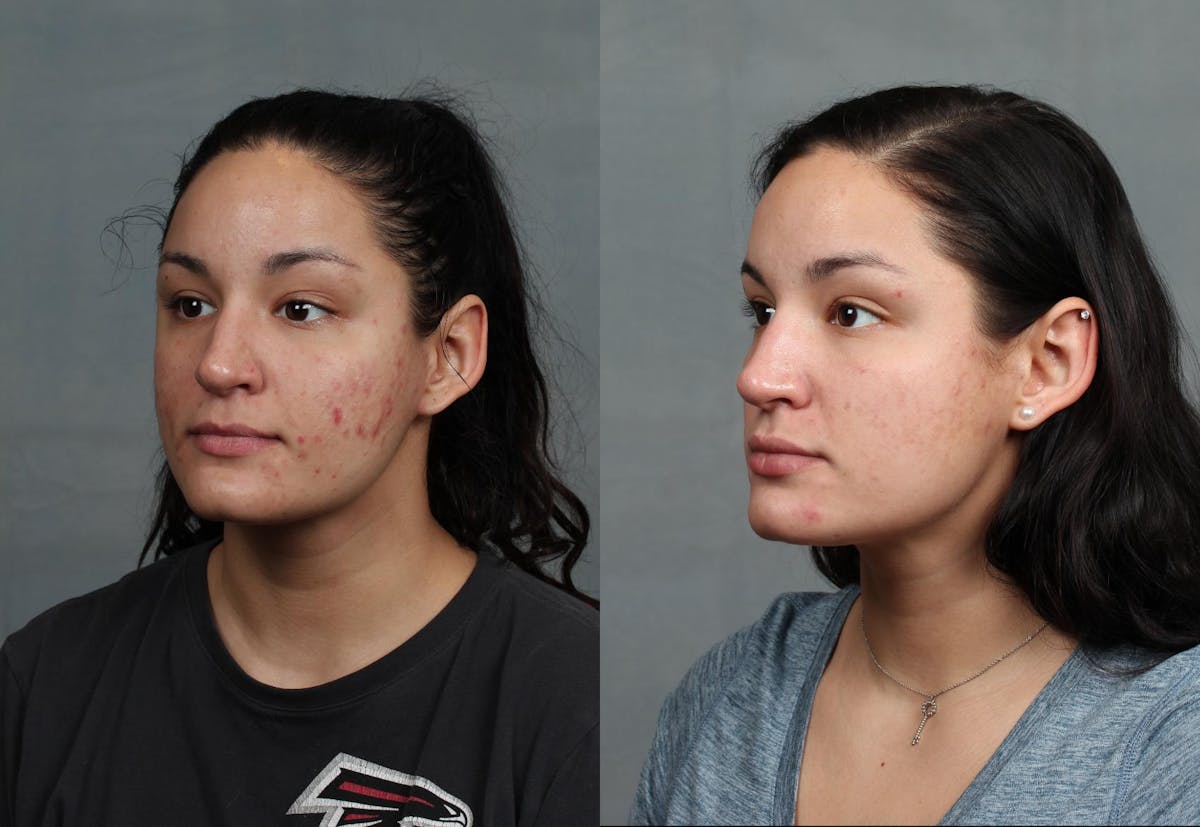 Advanced Medical Facials Before & After Gallery - Patient 583528 - Image 2