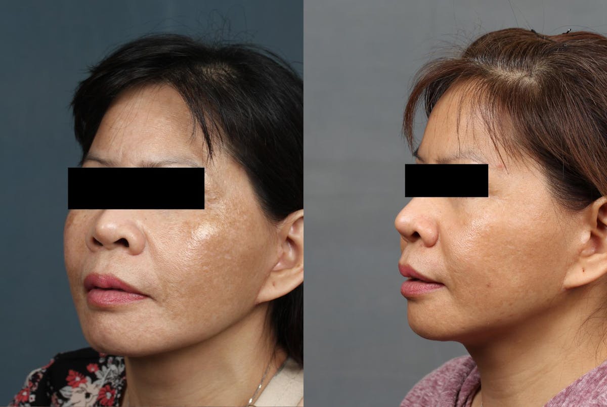 Advanced Medical Facials Before & After Gallery - Patient 427982 - Image 2
