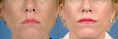 BOTOX® Cosmetic Before & After Gallery - Patient 120644 - Image 1