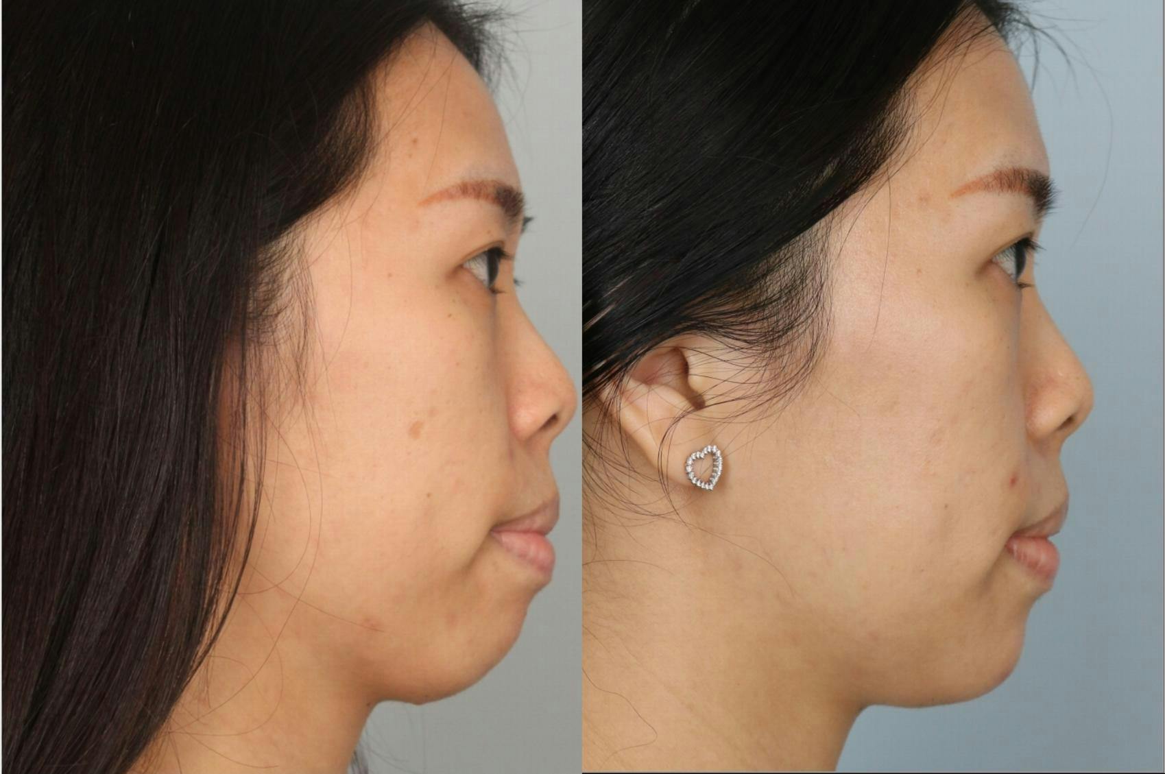 BOTOX® Cosmetic Before & After Gallery - Patient 245786 - Image 2