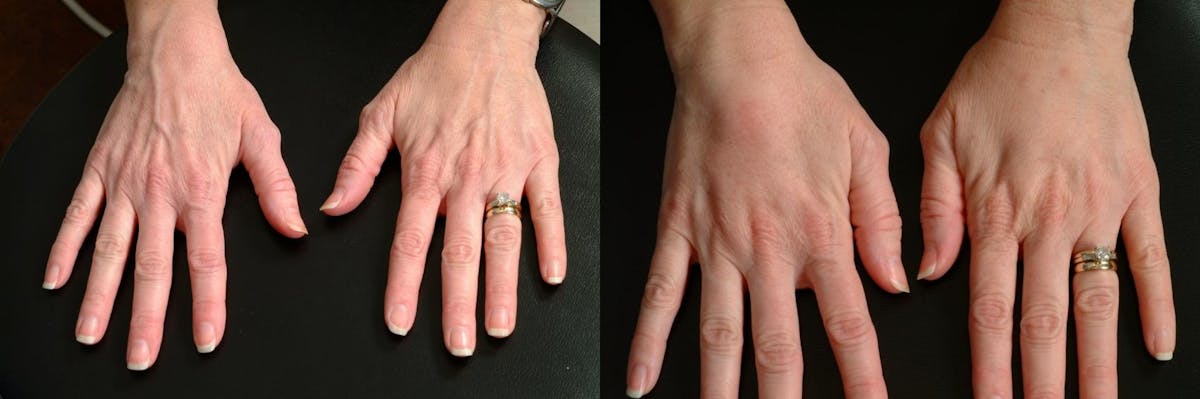 Hand Rejuvenation Before & After Gallery - Patient 547264 - Image 1