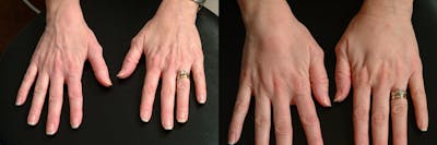 Hand Rejuvenation Before & After Gallery - Patient 547264 - Image 1