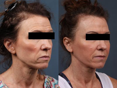 Dermal Fillers Before & After Gallery - Patient 322584 - Image 1