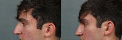 Dermal Fillers Before & After Gallery - Patient 204002 - Image 1