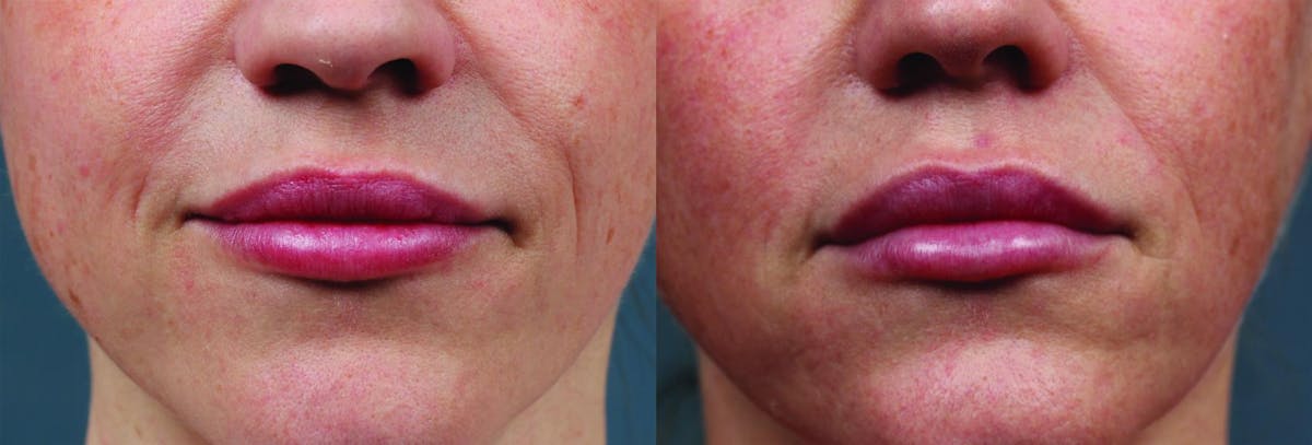 Dermal Fillers Before & After Gallery - Patient 279042 - Image 1