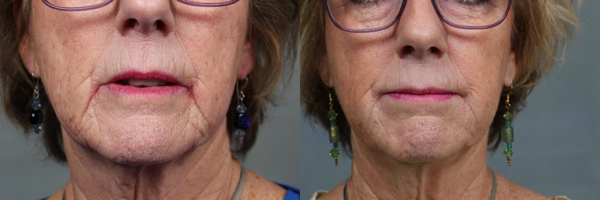 Dermal Fillers Before & After Gallery - Patient 959745 - Image 1
