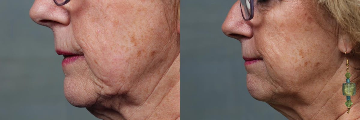Dermal Fillers Before & After Gallery - Patient 959745 - Image 2