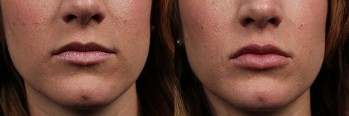 Lip Injections Before & After Gallery - Patient 165259 - Image 1