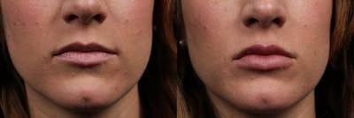 Dermal Fillers Before & After Gallery - Patient 355587 - Image 1