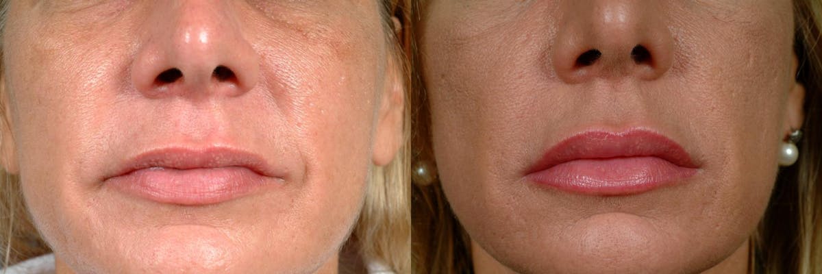 Dermal Fillers Before & After Gallery - Patient 220595 - Image 1