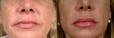 Dermal Fillers Before & After Gallery - Patient 220595 - Image 1