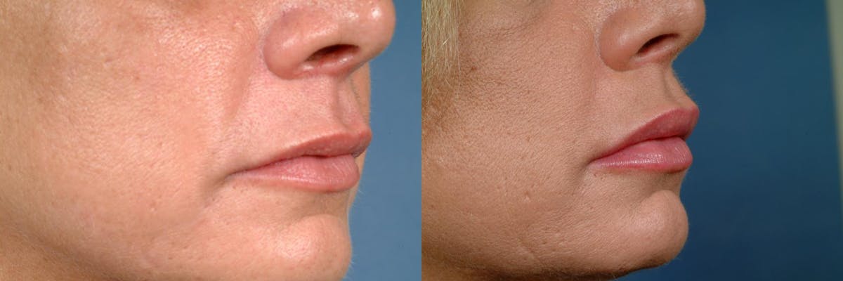 Dermal Fillers Before & After Gallery - Patient 220595 - Image 2