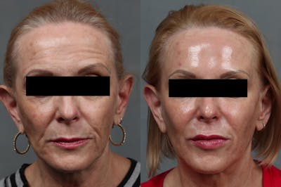 Dermal Fillers Before & After Gallery - Patient 726417 - Image 1