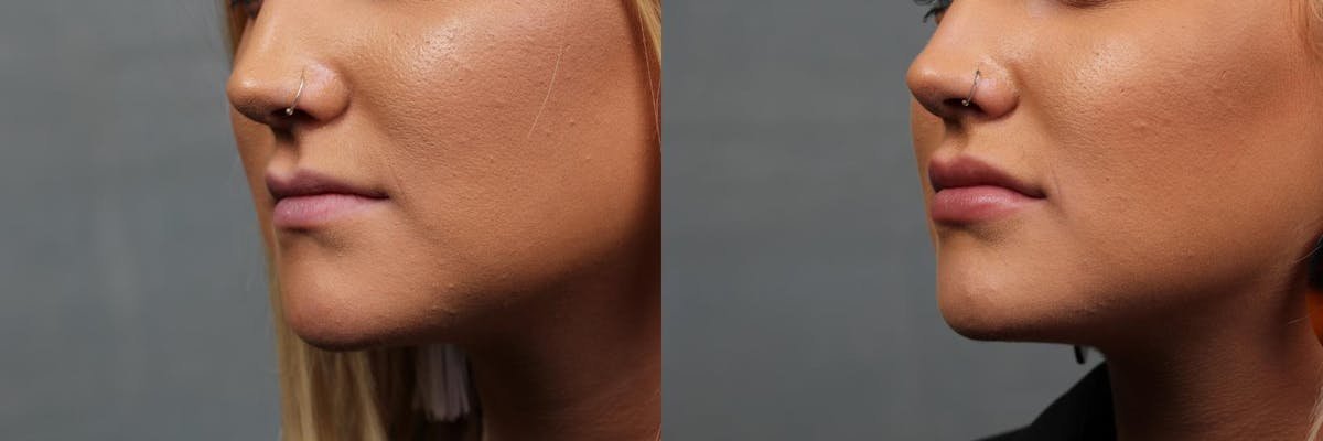 Lip Injections Before & After Gallery - Patient 403418 - Image 2