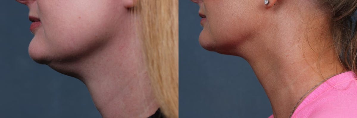 KYBELLA Before & After Gallery - Patient 916051 - Image 1