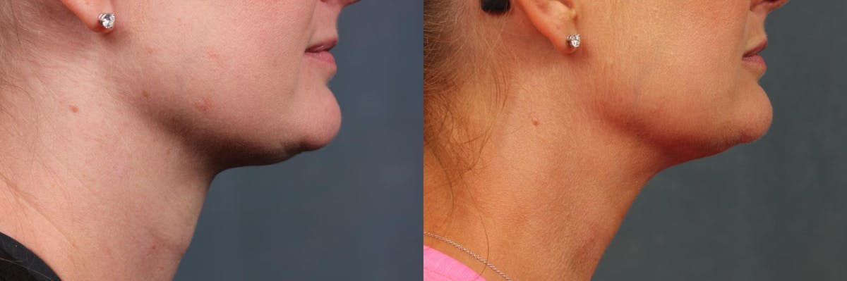 KYBELLA Before & After Gallery - Patient 916051 - Image 2