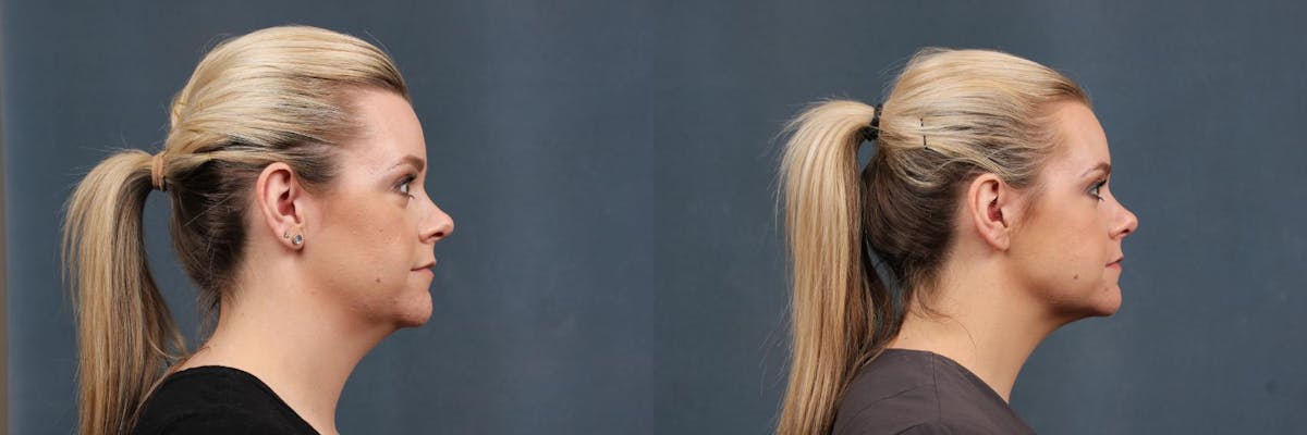 KYBELLA Before & After Gallery - Patient 145230 - Image 1