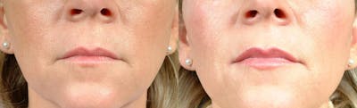 Dermal Fillers Before & After Gallery - Patient 383221 - Image 1