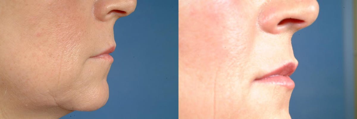 Dermal Fillers Before & After Gallery - Patient 383221 - Image 2