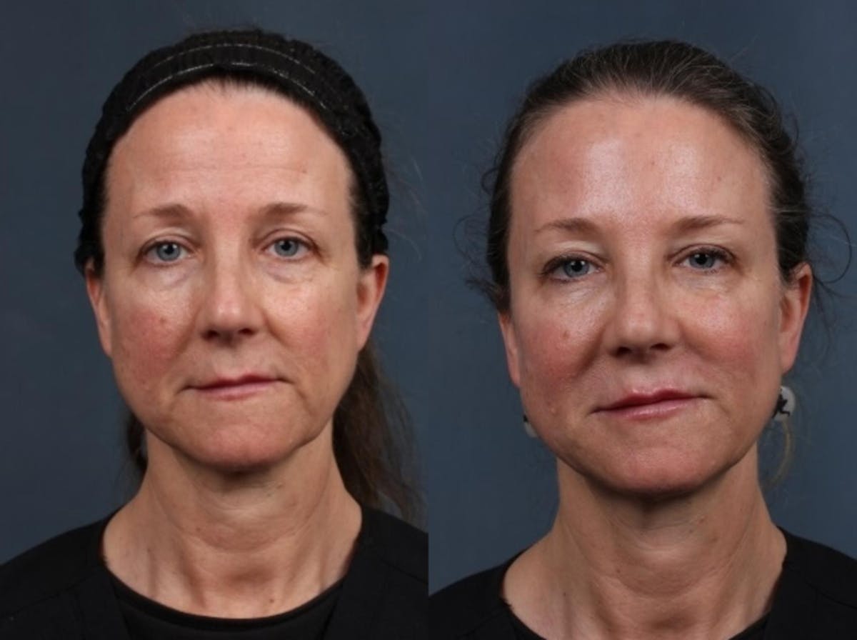 Dermal Fillers Before & After Gallery - Patient 263602 - Image 1