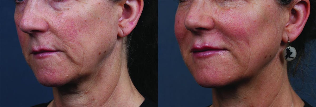 Dermal Fillers Before & After Gallery - Patient 263602 - Image 2