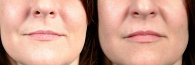Dermal Fillers Before & After Gallery - Patient 427631 - Image 1