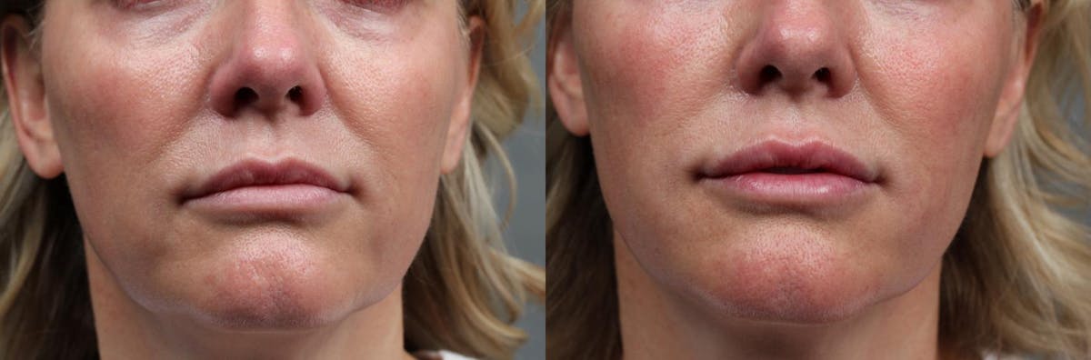 Dermal Fillers Before & After Gallery - Patient 209763 - Image 1