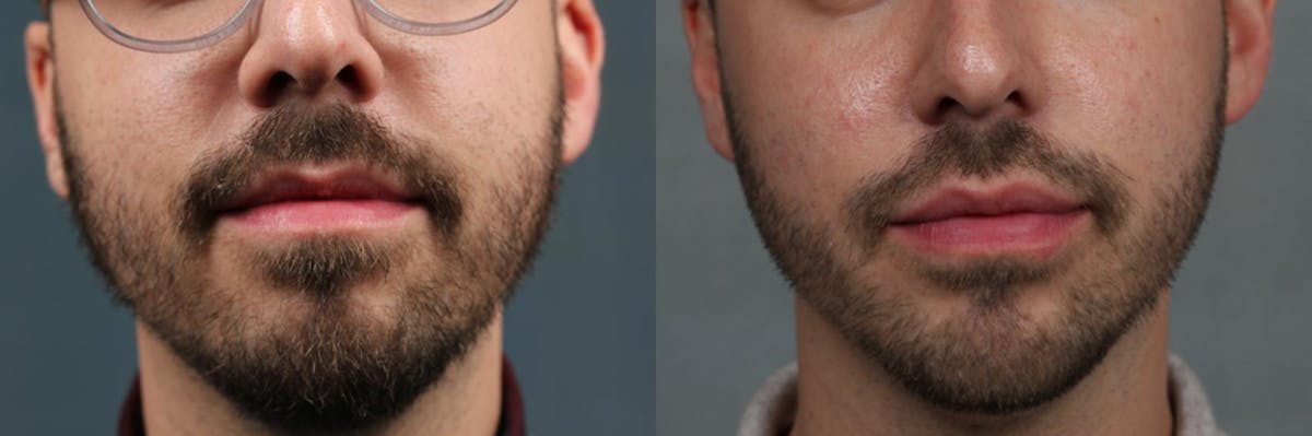 Lip Injections Before & After Gallery - Patient 275771 - Image 1