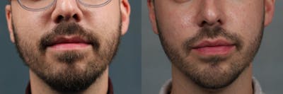 Dermal Fillers Before & After Gallery - Patient 223686 - Image 1