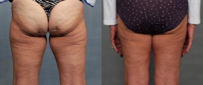 Cellulite Treatments Before & After Gallery - Patient 423603 - Image 1
